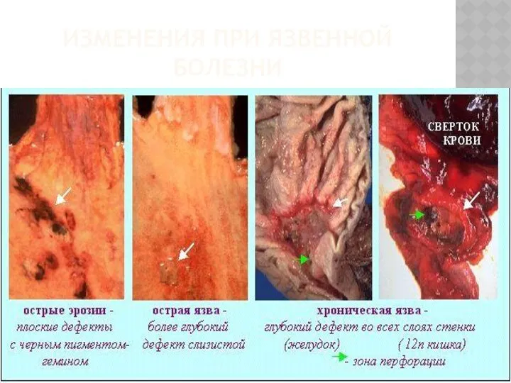 ИЗМЕНЕНИЯ ПРИ ЯЗВЕННОЙ БОЛЕЗНИ