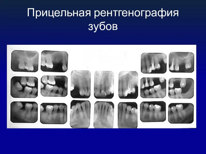 Прицельная рентгенография зубов
