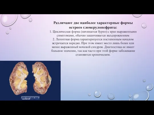 Различают две наиболее характерные формы острого гломерулонефрита: 1. Циклическая форма (начинается