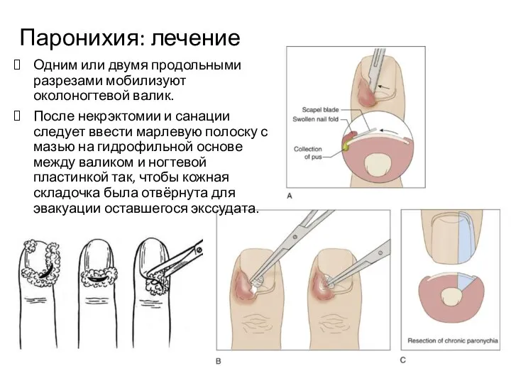 Паронихия: лечение Одним или двумя продольными разрезами мобилизуют околоногтевой валик. После