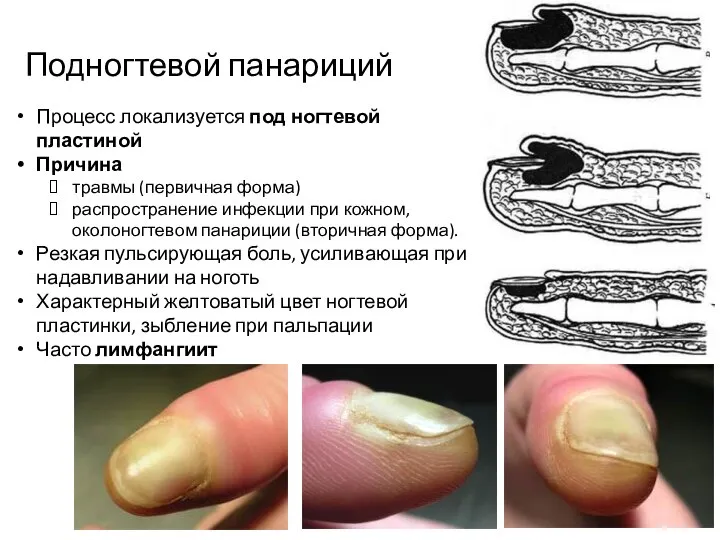 Подногтевой панариций Процесс локализуется под ногтевой пластиной Причина травмы (первичная форма)