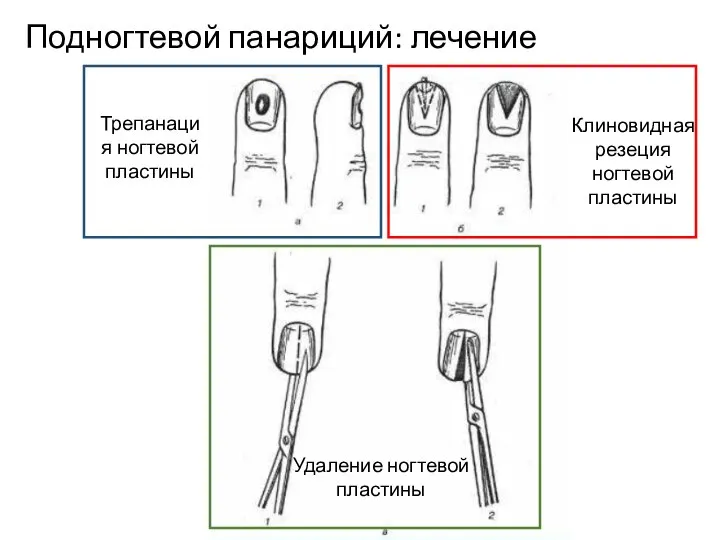 Подногтевой панариций: лечение Трепанация ногтевой пластины Удаление ногтевой пластины Клиновидная резеция ногтевой пластины