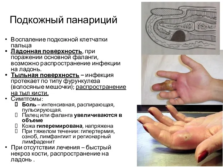 Подкожный панариций Воспаление подкожной клетчатки пальца Ладонная поверхность, при поражении основной