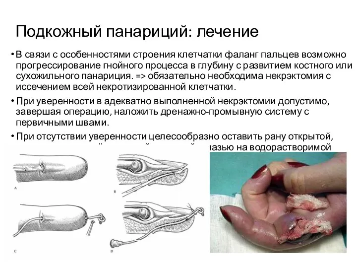 Подкожный панариций: лечение В связи с особенностями строения клетчатки фаланг пальцев