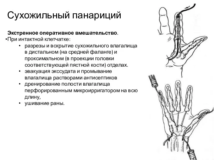 Сухожильный панариций Экстренное оперативное вмешательство. При интактной клетчатке: разрезы и вскрытие