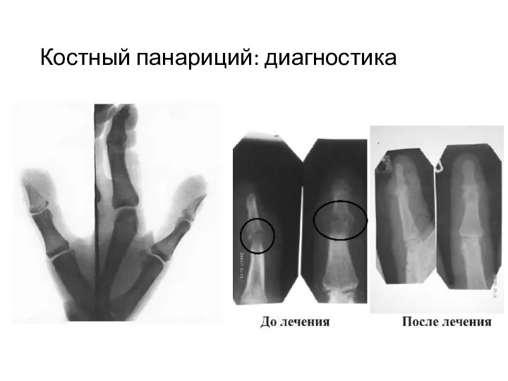 Костный панариций: диагностика