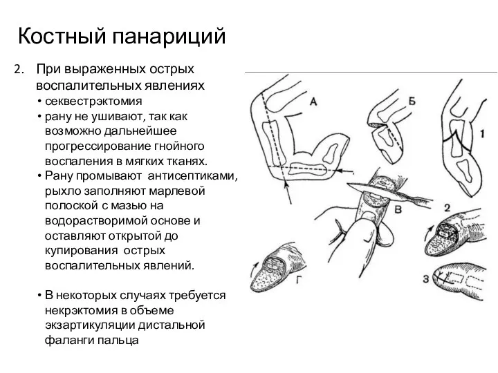 Костный панариций При выраженных острых воспалительных явлениях секвестрэктомия рану не ушивают,