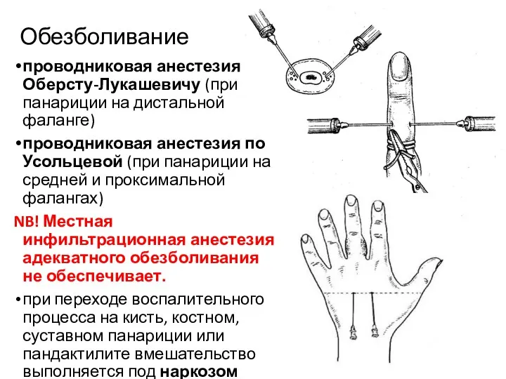 Обезболивание проводниковая анестезия по Оберсту-Лукашевичу (при панариции на дистальной фаланге) проводниковая