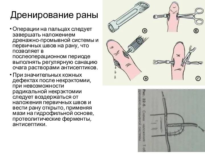 Дренирование раны Операции на пальцах следует завершать наложением дренажно-промывной системы и