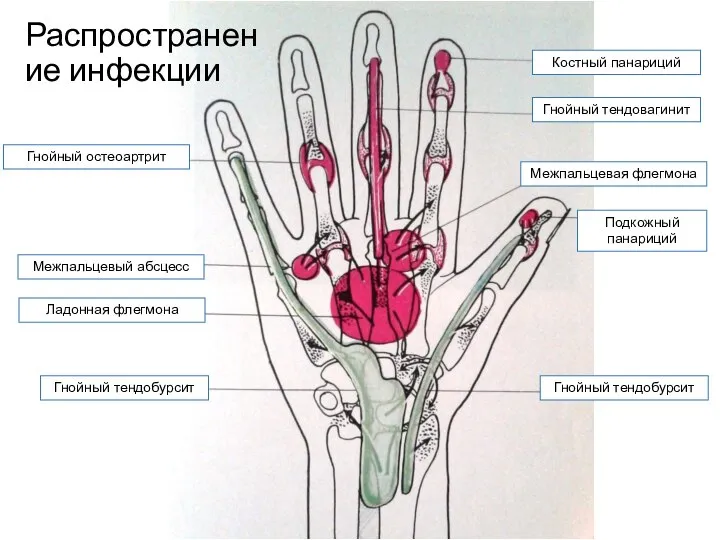 Подкожный панариций Костный панариций Гнойный тендовагинит Гнойный тендобурсит Межпальцевый абсцесс Межпальцевая