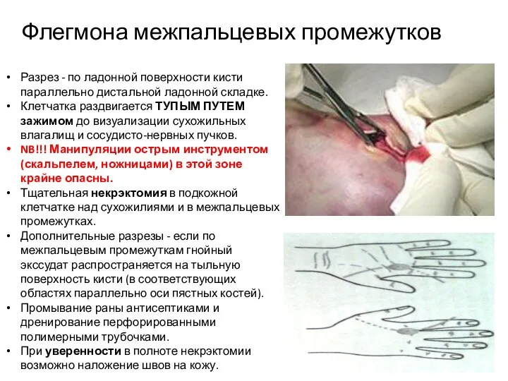 Флегмона межпальцевых промежутков Разрез - по ладонной поверхности кисти параллельно дистальной