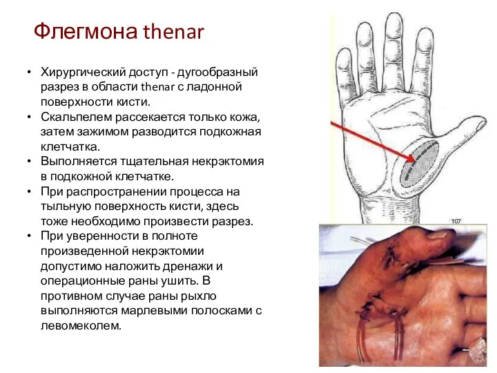 Флегмона thenar Хирургический доступ - дугообразный разрез в области thenar с