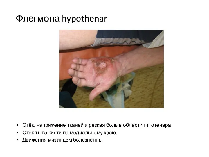 Флегмона hypothenar Отёк, напряжение тканей и резкая боль в области гипотенара