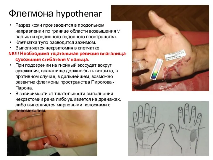 Флегмона hypothenar Разрез кожи производится в продольном направлении по границе области