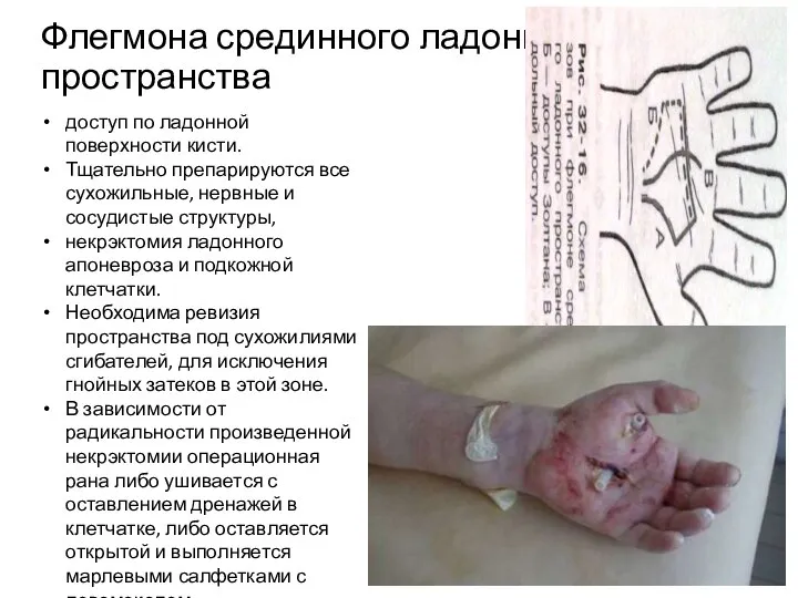 Флегмона срединного ладонного пространства доступ по ладонной поверхности кисти. Тщательно препарируются