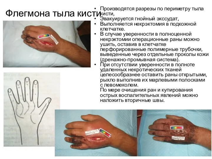 Флегмона тыла кисти Производятся разрезы по периметру тыла кисти, Эвакуируется гнойный