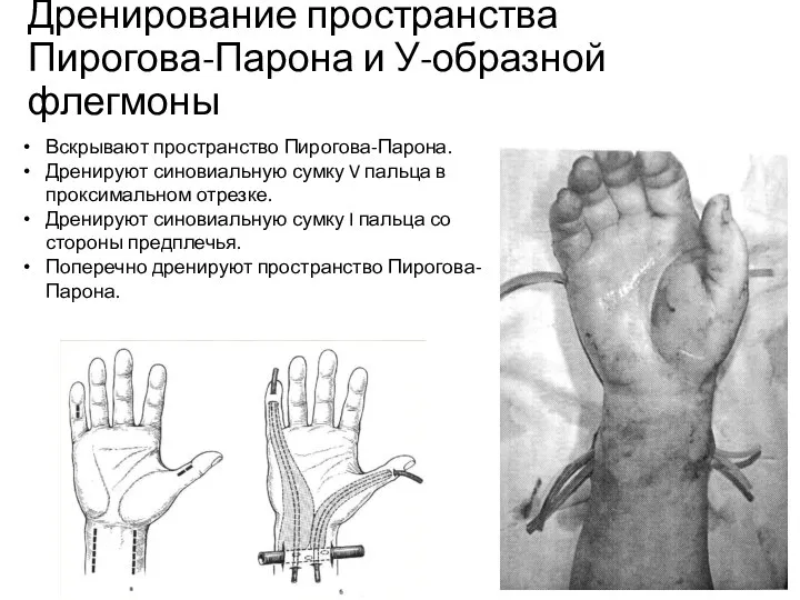 Дренирование пространства Пирогова-Парона и У-образной флегмоны Вскрывают пространство Пирогова-Парона. Дренируют синовиальную