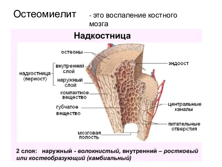 Остеомиелит - это воспаление костного мозга