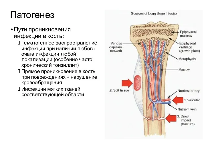 Патогенез Пути проникновения инфекции в кость: Гематогенное распространение инфекции при наличии