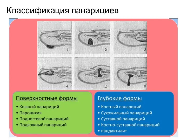 Классификация панарициев