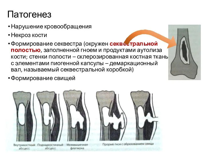 Патогенез Нарушение кровообращения Некроз кости Формирование секвестра (окружен секвестральной полостью, заполненной