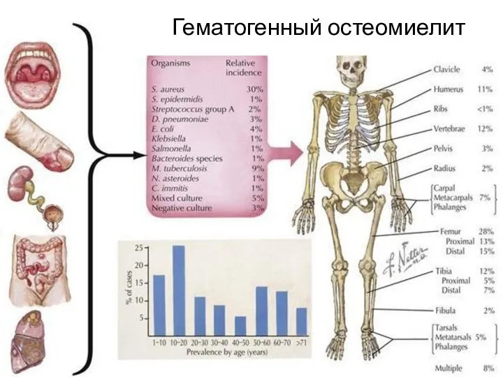 Гематогенный остеомиелит