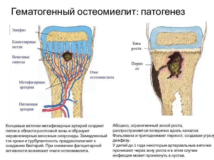 Гематогенный остеомиелит: патогенез Концевые веточки метафизарных артерий создают петли в области