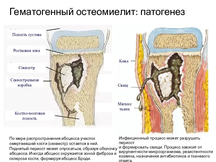 Гематогенный остеомиелит: патогенез По мере распространения абсцесса участок омертвевшей кости (секвестр)