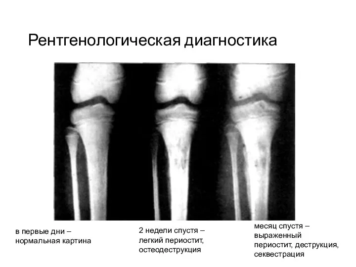 Рентгенологическая диагностика месяц спустя – выраженный периостит, деструкция, секвестрация 2 недели