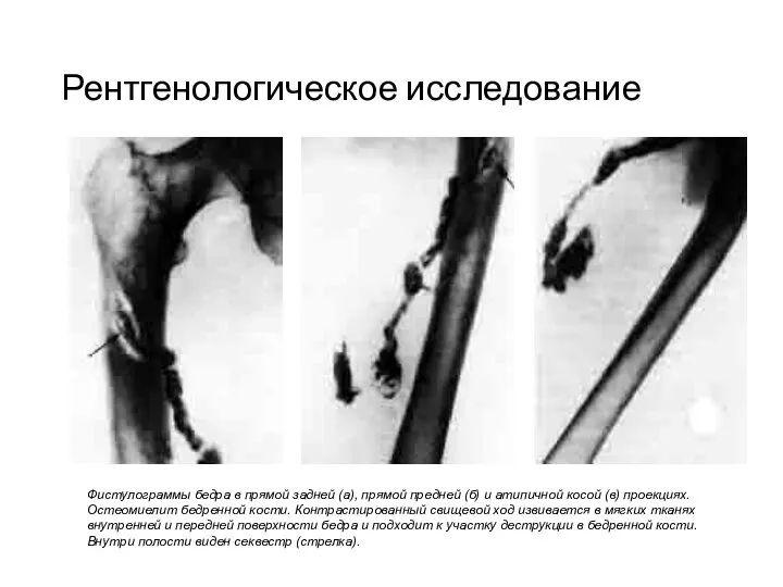 Рентгенологическое исследование Фистулограммы бедра в прямой задней (а), прямой предней (б)