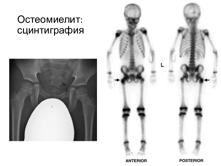 Остеомиелит: сцинтиграфия