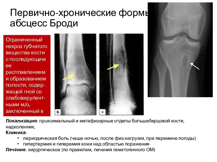 Первично-хронические формы: абсцесс Броди Локализация: проксимальный и метафизарные отделы большеберцовой кости,