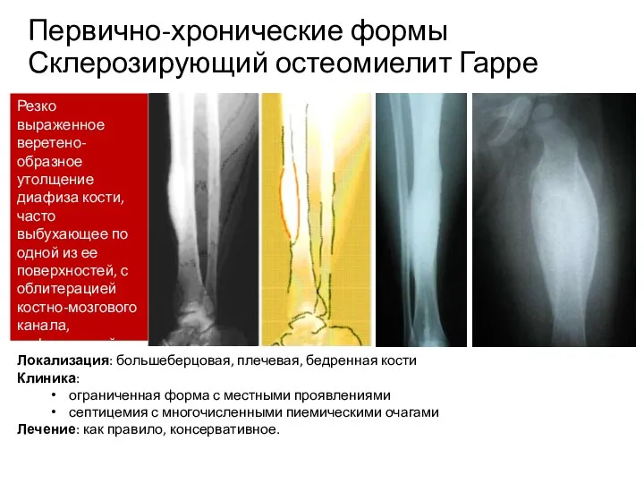 Первично-хронические формы Склерозирующий остеомиелит Гарре Резко выраженное веретено-образное утолщение диафиза кости,