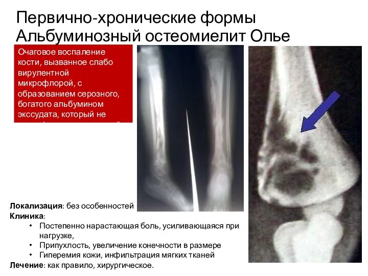 Первично-хронические формы Альбуминозный остеомиелит Олье Очаговое воспаление кости, вызванное слабо вирулентной