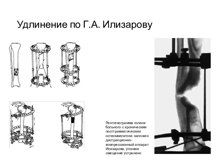 Удлинение по Г.А. Илизарову Рентгенограмма голени больного с хроническим посттравматическим остеомиелитом: