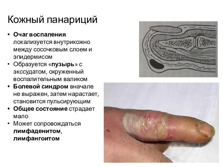 Кожный панариций Очаг воспаления локализуется внутрикожно между сосочковым слоем и эпидермисом