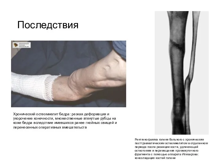 Последствия Рентгенограмма голени больного с хроническим посттравматическим остеомиелитом в отдаленном периоде