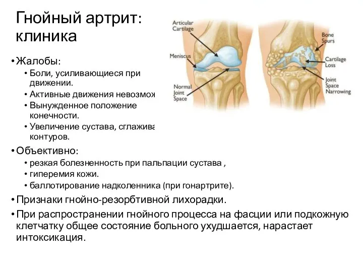 Гнойный артрит: клиника Жалобы: Боли, усиливающиеся при движении. Активные движения невозможны,