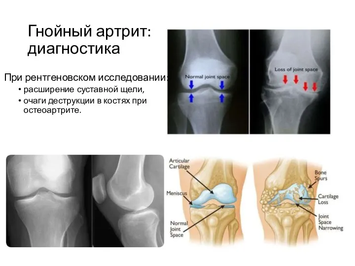 Гнойный артрит: диагностика При рентгеновском исследовании: расширение суставной щели, очаги деструкции в костях при остеоартрите.