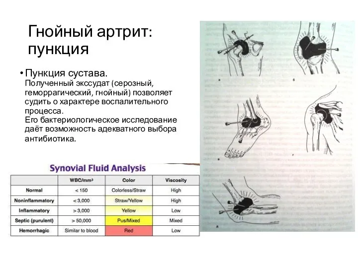 Гнойный артрит: пункция Пункция сустава. Полученный экссудат (серозный, геморрагический, гнойный) позволяет