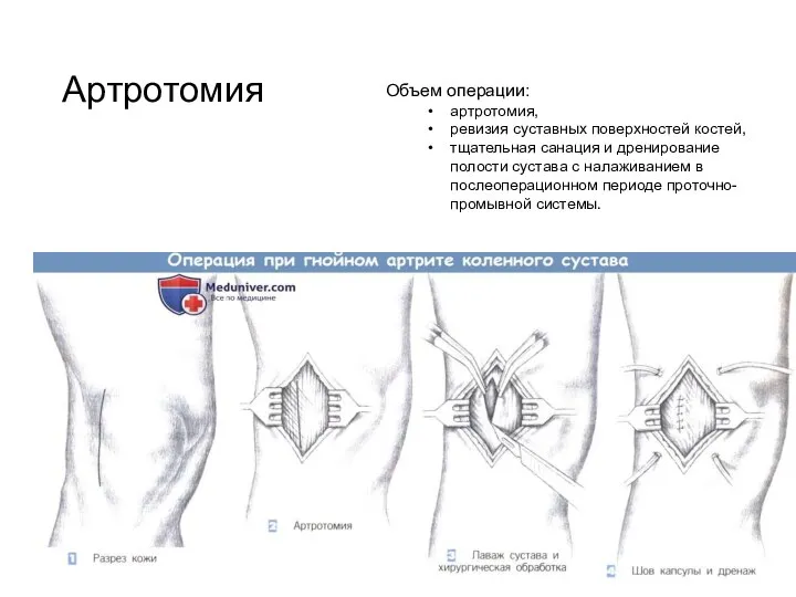 Артротомия Объем операции: артротомия, ревизия суставных поверхностей костей, тщательная санация и