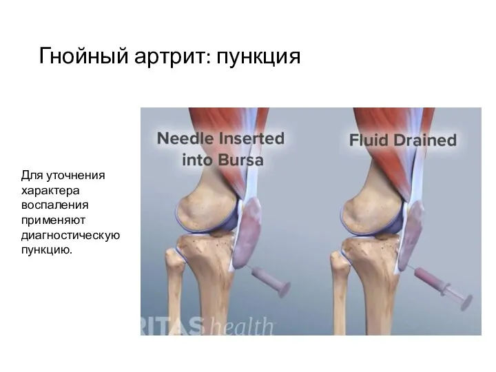 Гнойный артрит: пункция Для уточнения характера воспаления применяют диагностическую пункцию.
