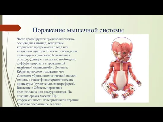 Поражение мышечной системы Часто травмируется грудино-ключично-сосцевидная мышца, вследствие ягодичного предлежания плода