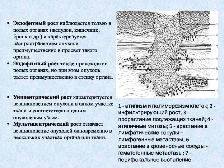 1 - атипизм и полиморфизм клеток; 2 - инфильтрирующий рост; 3