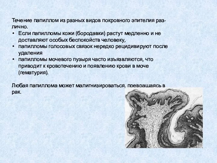 Течение папиллом из разных видов покровного эпителия раз- лично. Если папилломы