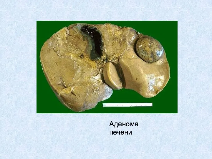 Аденома печени