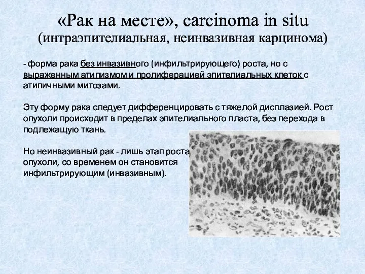 «Рак на месте», carcinoma in situ (интраэпителиальная, неинвазивная карцинома) - форма