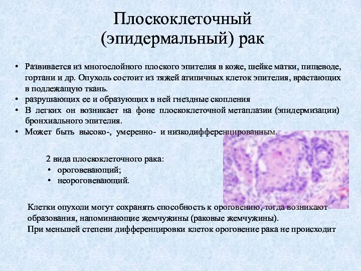 Плоскоклеточный (эпидермальный) рак Развивается из многослойного плоского эпителия в коже, шейке