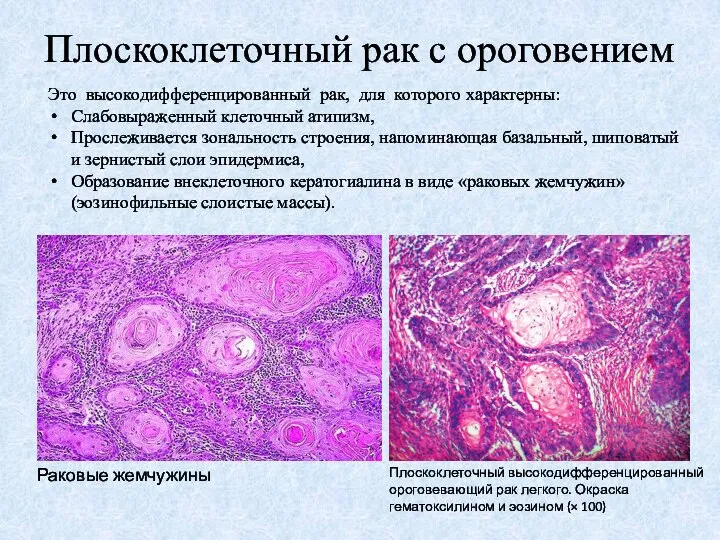 Плоскоклеточный рак с ороговением Это высокодифференцированный рак, для которого характерны: Слабовыраженный