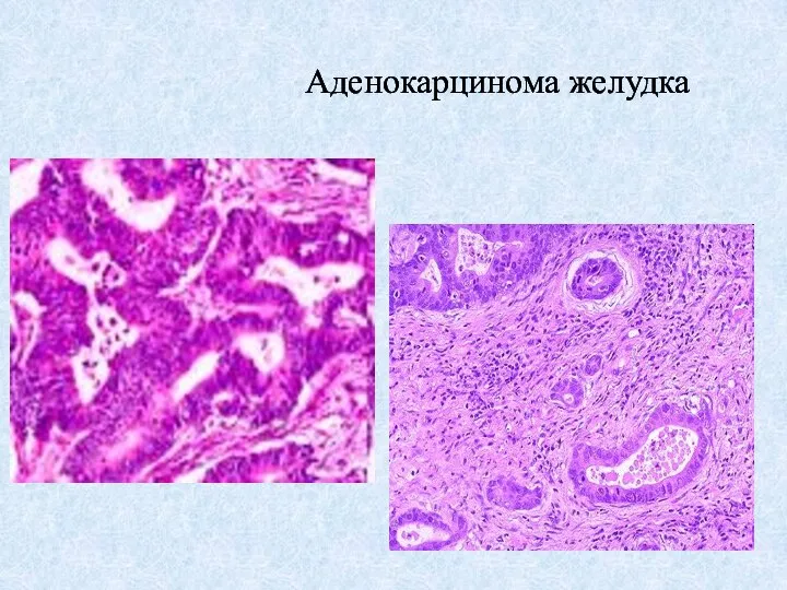 Аденокарцинома желудка